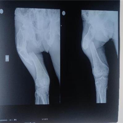 Polyostotic Fibrous Dysplasia Complicated by Pathological Fracture of Right Femoral Shaft with Nonunion: A Case Report